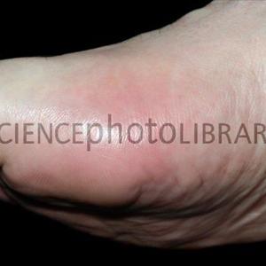 Food That Lower Uric Acid Levels - Some Home Based Treatments To Eliminate Gout