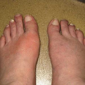 Gout Information - Natural Treatments For Gout - No More Pain &Amp; Inflammation