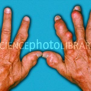 Does Gout Cure Work - Fish Oil As Well As Gout - Could This Function As The Cure