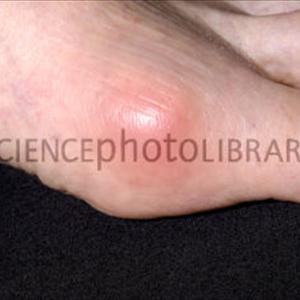 Zylofirm Gout Medicine - Get Treatment With This Diet For Gout