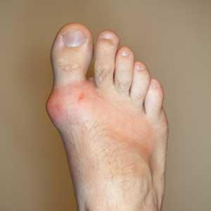 Does Eating Rice Cause Gout - List Of Meals To Avoid When You Have Gout