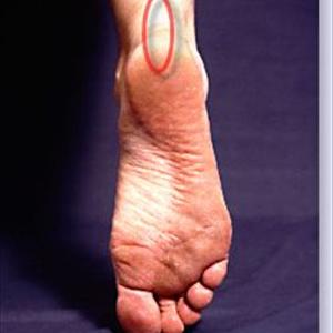 Natural Gout - Hindering Gout