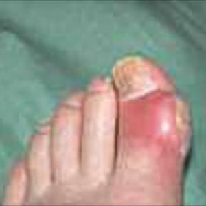 Low Purine Foods - Just How Reliable Could Be The Gout Pain Medication