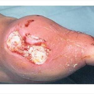 What Is The Correct Uric Acid Level To Be - Beneficial Facts Upon Eliminating Gout Symptoms