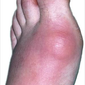 Is Salmon High In Uric Acid Level - What To Do When Your Feet Is Swollen Because Of Gout