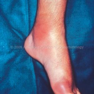 Liquor And Gout - Alternative Gout Treatments