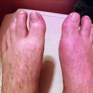 Vegetables Bad For Gout Attack - What Is Actually Gout And How Can You Treat It Naturally?